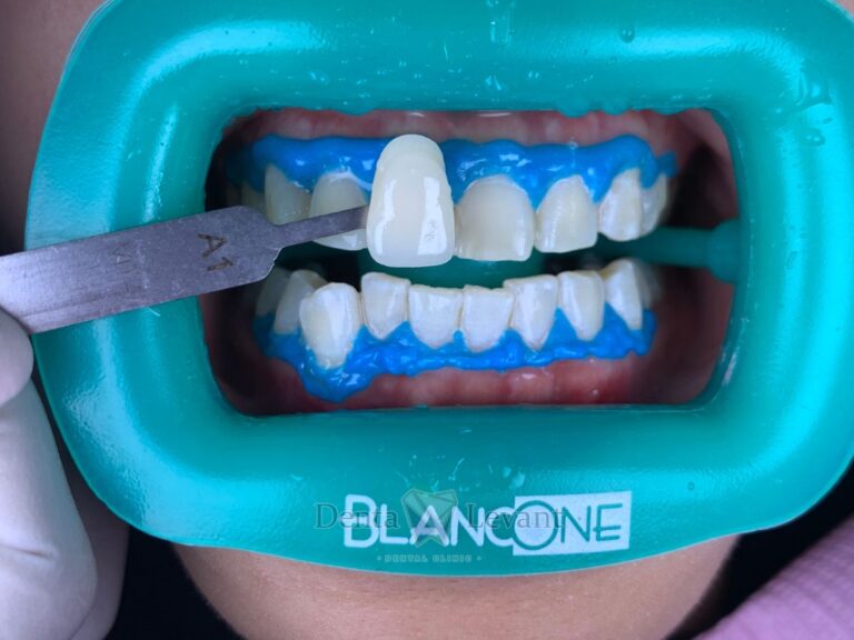 Whitening 11